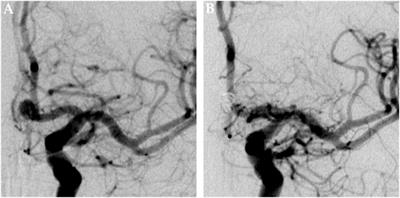 Stent-Assisted Coiling of Ruptured and Incidental Aneurysms of the Intracranial Circulation Using Moderately Flow-Redirecting, Braided Leo Stents—Initial Experience in 39 Patients